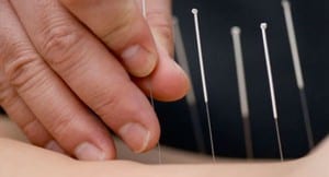 Acupuncture is a versatile treatment.